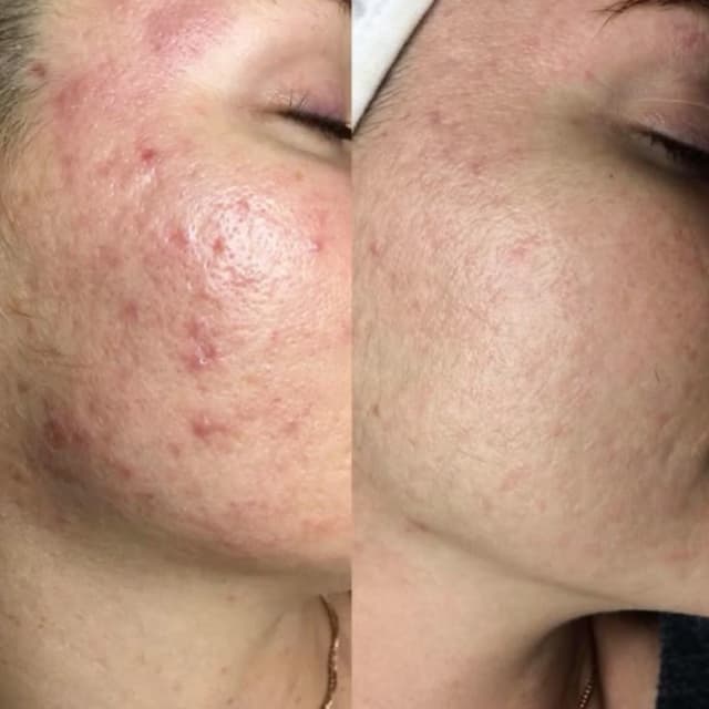Crystal Clear Acne Bootcamp at Hoosier Beauties in Bloomington, IN